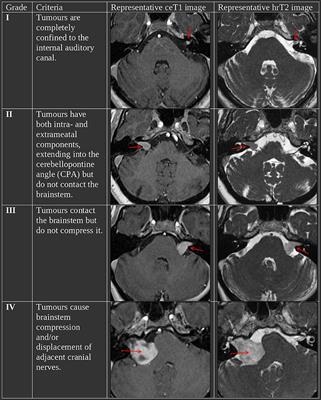 Frontiers | Automated Koos Classification of Vestibular Schwannoma