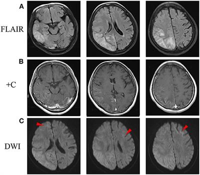 Frontiers | A Case Report of Neuronal Intranuclear Inclusion Disease ...