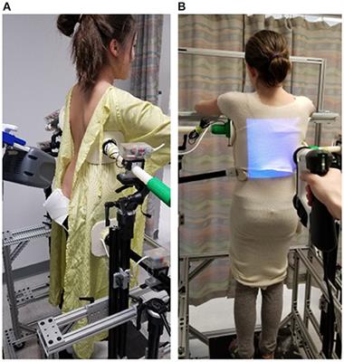 My Care Prosthetics and Orthotics on X: Boston brace for scoliosis is a  plastic body jacket used in the treatment of adolescents with idiopathic  scoliosis. The Boston brace, also referred to as