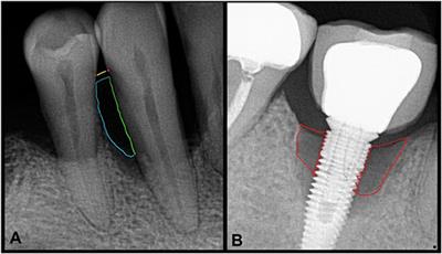 moderate periodontitis radiograph
