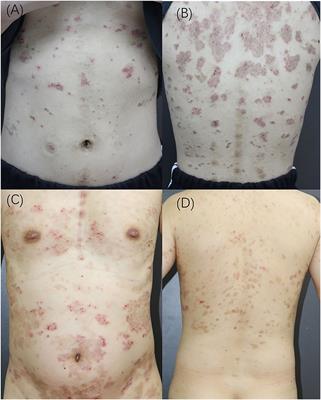 Frontiers | Case Report: Pemphigus in Young Patients With Thymic Anomalies