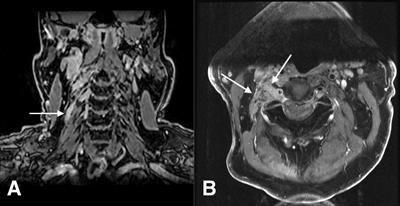 Frontiers | Neurotropic Cutaneous Malignancies: Case Report on ...