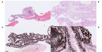 Characterization of the 'White' Appearing Clots that Cause Acute