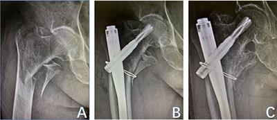 Frontiers | When to Reduce and Fix Displaced Lesser Trochanter in ...