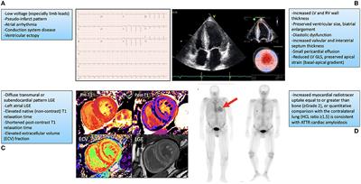 Prognostic value of right ventricular global longitudinal strain in  transthyretin amyloid cardiomyopathy - Journal of Cardiology