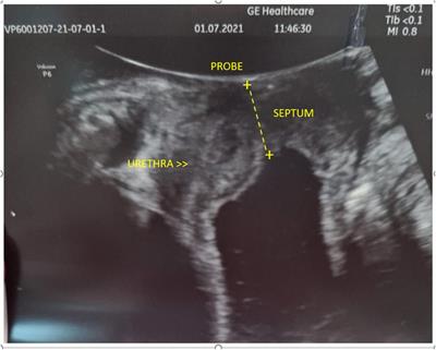 Frontiers | Case report: Hydrometrocolpos conditioning recurrent ...