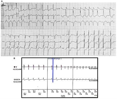 Frontiers | Case Report: Pulmonary Vein Isolation as a Tailored ...