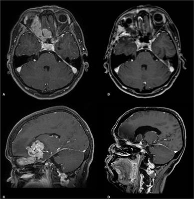 Frontiers | Case Report: Esthesioneuroblastoma Involving the Optic Pathways