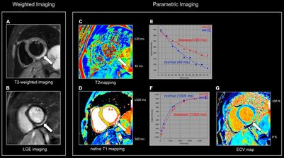 T2 Relaxation Times at Cardiac MRI in Healthy Adults: A Systematic