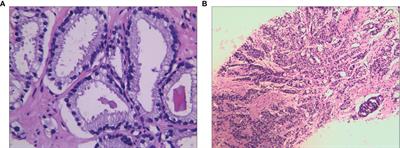 Frontiers | Case Report: 18F-PSMA-1007 PET/CT Avid Solitary Penile ...