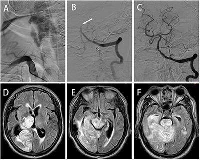 Frontiers | Case Report: Stroke Chameleon: Acute Large Vessel Occlusion ...