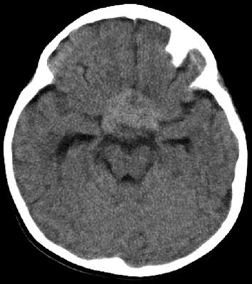 Frontiers | Optic Pathway–Hypothalamic Glioma Apoplexy: A Report of Two ...