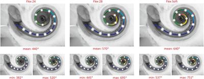 EAS Candidacy for High-Frequency Hearing Loss - MED-EL