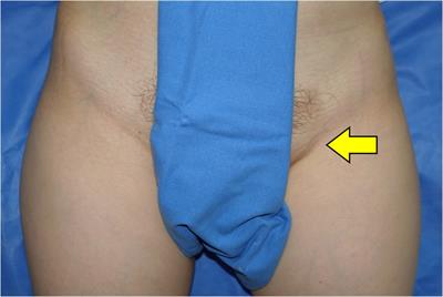 Extra (supernumerary or accessory) nipples or breast tissue