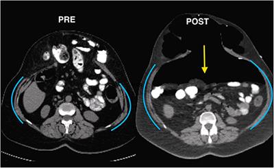 Frontiers | Editorial: Botox in Complex Abdominal Wall Surgery