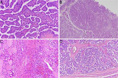 Frontiers | Predictive Biomarkers in Thyroid Cancer