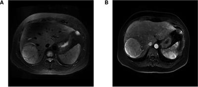 Inflammatory myofibroblastic tumour of an unusual presentation in