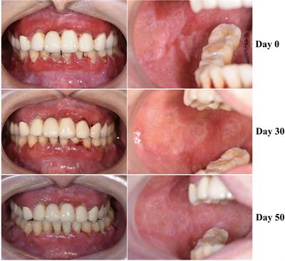 Frontiers | Case Report: Mucous Membrane Pemphigoid With IgG and IgA ...