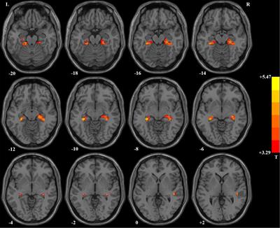 Frontiers | Abnormal spontaneous neural activity in hippocampal ...