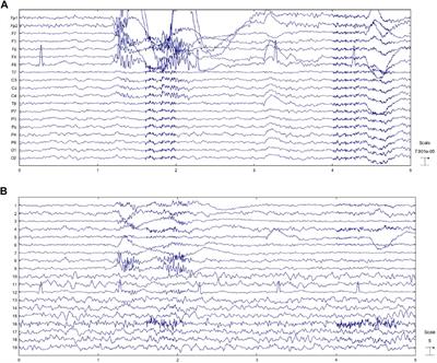 PDF) Decomposing Tool-Action Observation: A Stereo-EEG Study