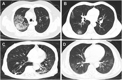 Frontiers | Clinical Characteristics of COVID-19 Patients Infected by ...