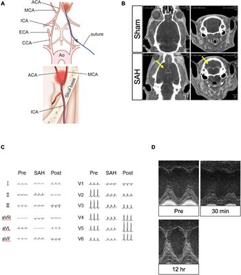 The subarachnoid hemorrhage (SAH) stages. The yellow arrows