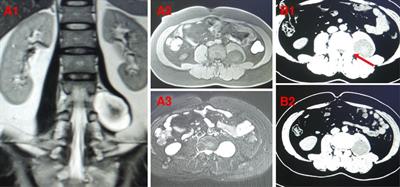 Frontiers | One step excision combined with unilateral transforaminal ...