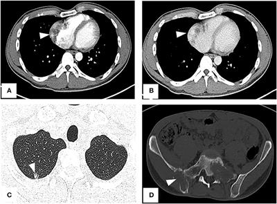 Frontiers | Case report: Primary cardiac angiosarcoma with multiple ...