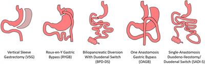 The Role Of Bariatric And Metabolic Surgery In The Development Diagnosis And Treatment Of Endometrial Cancer Frontiers