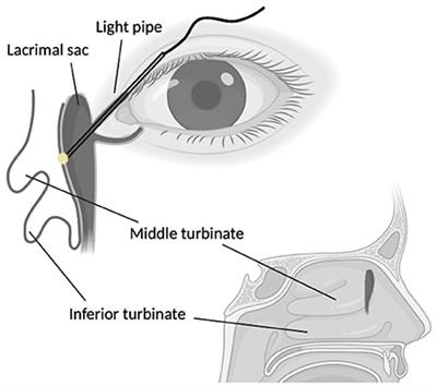 Frontiers | Endoscopic dacryocystorhinostomy with short-term, pushed ...