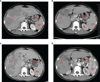 Frontiers | Case report: Significant response to PD-L1 inhibitor after ...