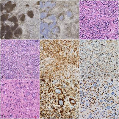 Frontiers  Nodular and diffuse spindle cell infiltration in