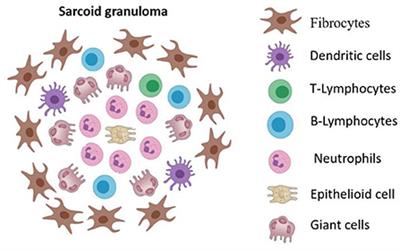 Frontiers | Sarcoidosis: Progression to the chronic stage and ...