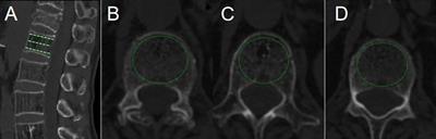 Frontiers | Risk factors of new vertebral compression fracture after ...