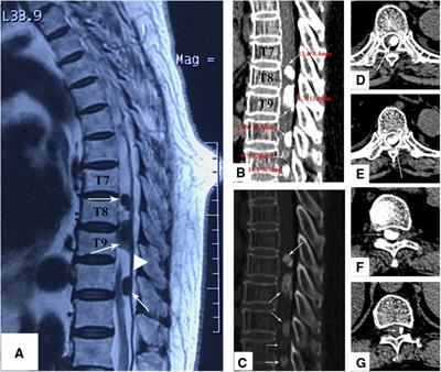 Thoracic Spine MRI scan