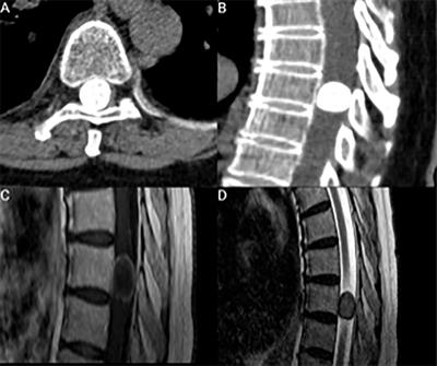 Frontiers | MAC-spinal meningioma score: A proposal for a quick-to-use ...