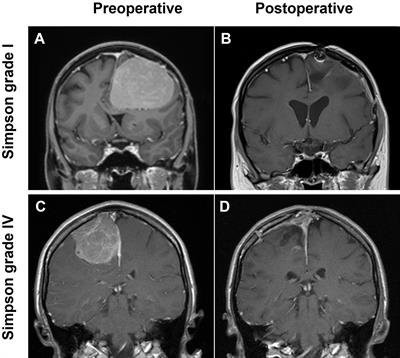 Frontiers Spinal Meningiomas From Biology To Management A