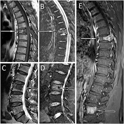 Frontiers | Case report: Thoracic and lumbar plasma cell myeloma ...