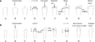 Frontiers | Factors affecting prepubertal and pubertal bone age progression