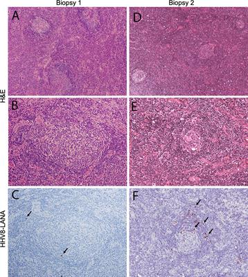 Frontiers | Case report: Multicentric Castleman disease as a ...