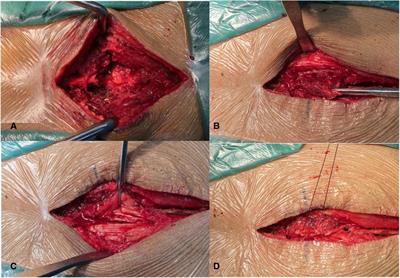 INGUINAL HERNIA REPAIR – CSF Surgery