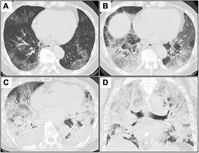 Frontiers | Negative-pressure wound therapy to treat thoracic empyema ...