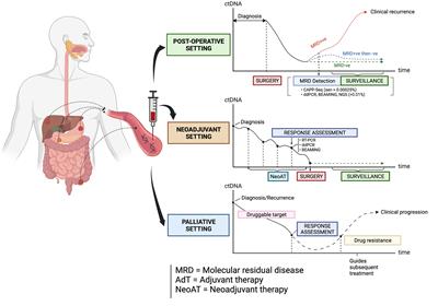 Circulating Tumor DNA Analysis Guiding Adjuvant Therapy in Stage II Colon  Cancer