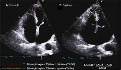 Frontiers  The Predictive Value of Right Ventricular Longitudinal Strain  in Pulmonary Hypertension, Heart Failure, and Valvular Diseases