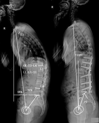 Frontiers | Optimal immediate sagittal alignment for kyphosis in ...