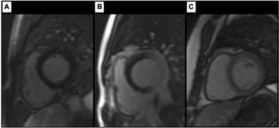 MRI-derived LV parameters of the study group in comparison to normal