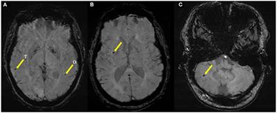 Frontiers | Atrial cardiopathy is associated with cerebral microbleeds ...