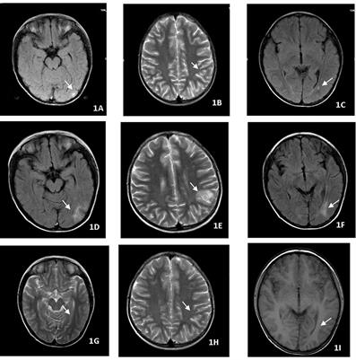 Frontiers | Case Report: Thalidomide in the treatment of complicated ...