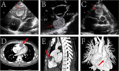 Frontiers | Case report: Right ventricular outflow tract obstruction ...