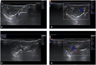 Frontiers | Feasibility analysis and study of an intrahepatic portal ...